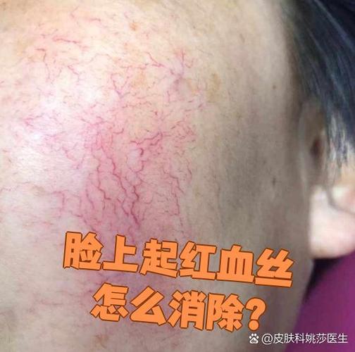 PS怎么添加脸部血丝效果？-图2