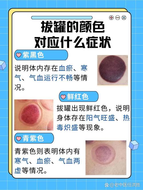 拔罐是痛还是爽?那种感觉咋形容?-图3 拔罐是痛还是爽?那种感觉咋形容?-图3